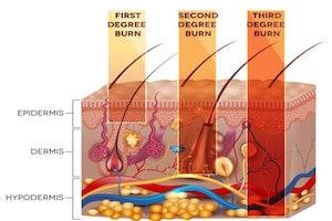 Types of Burn Degree