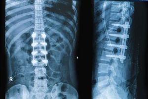 Spinal Fusion Trauma